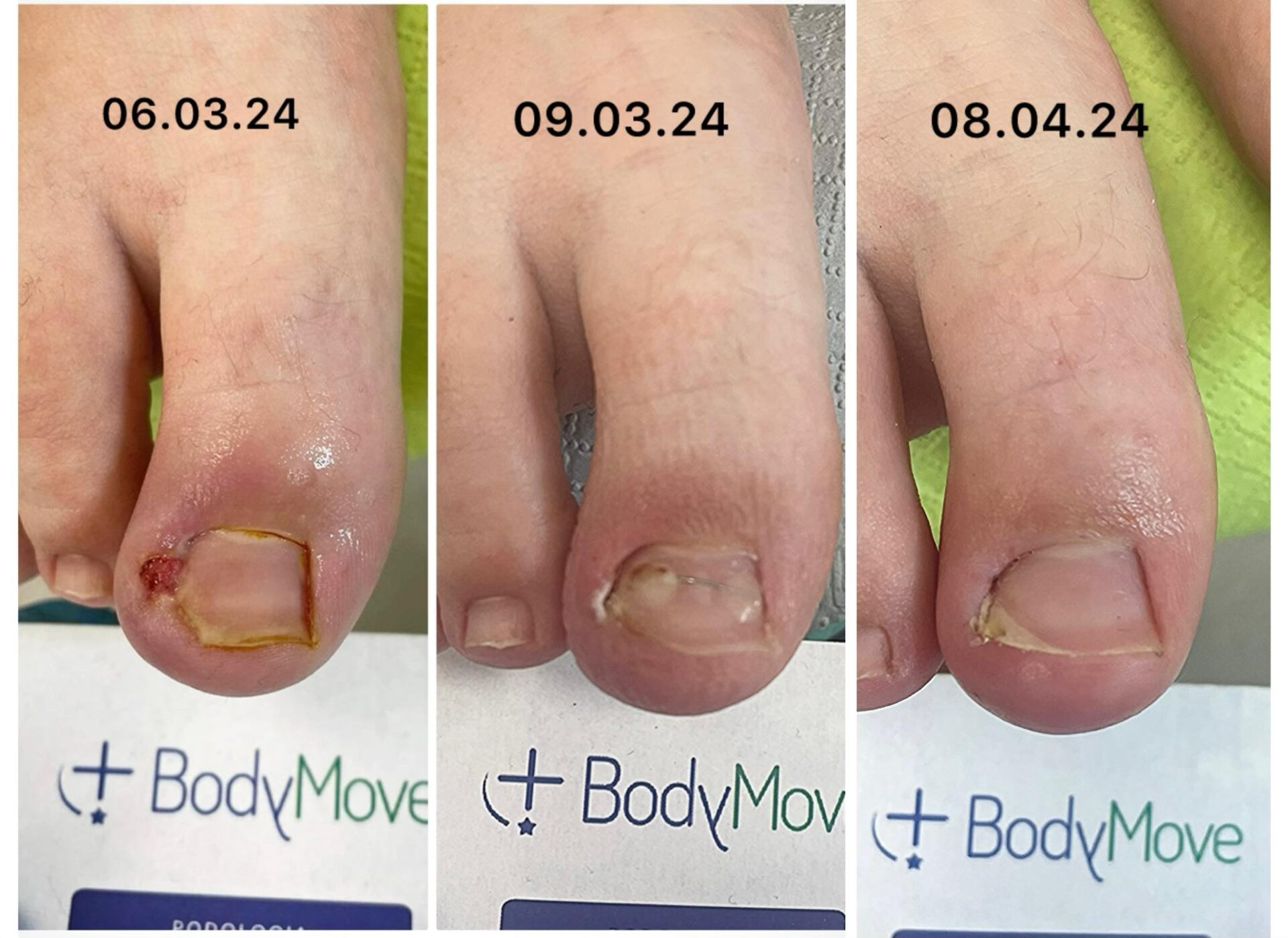 wrastajacy paznokiec