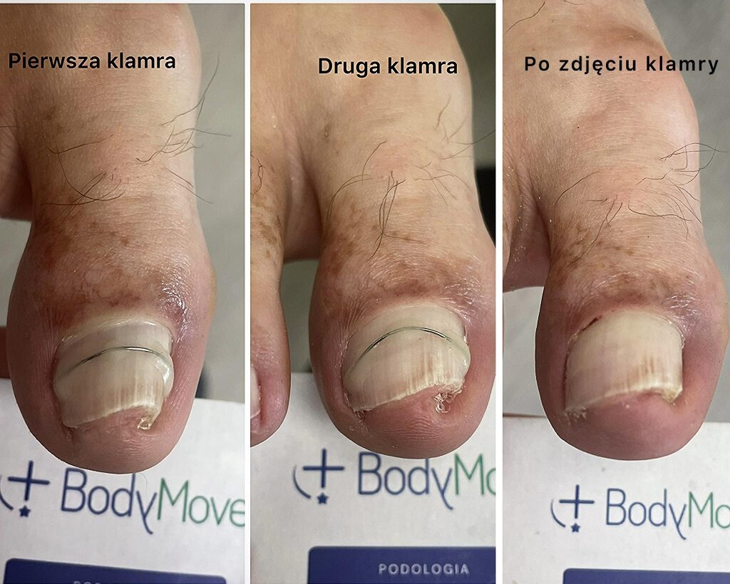 klamra tytanowa na paznokieć kraków