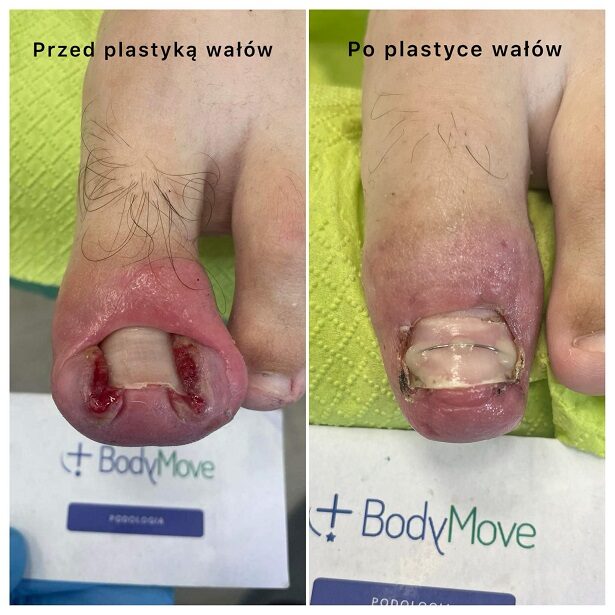 wrastający paznokieć leczenie kraków