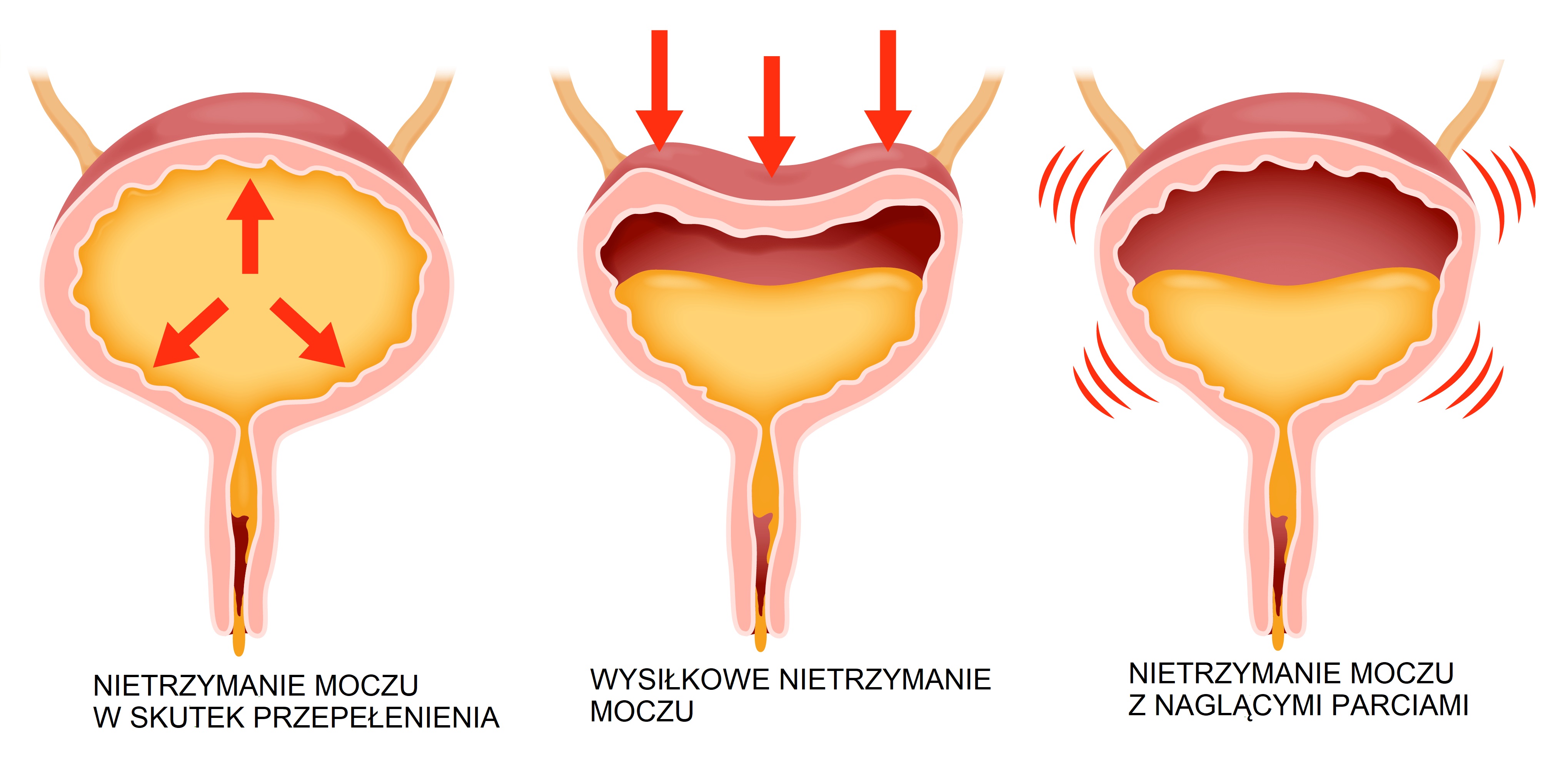 Rodzaje nietrzymania moczu