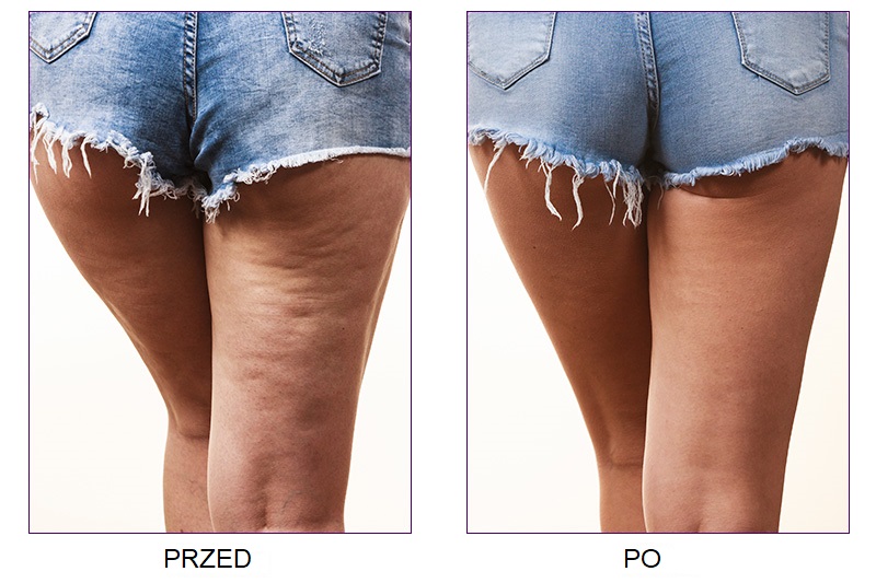 zabiegi ujędrniające kraków