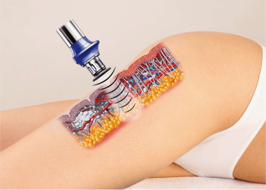 usuwanie cellulitu krakow